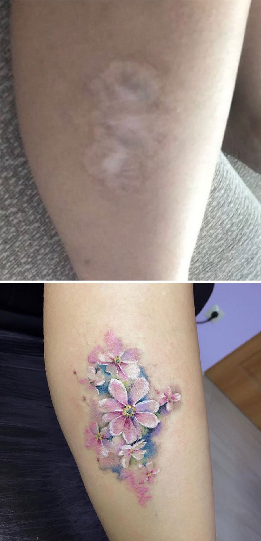 Scars-And-Birthmarks-Tattoo-Cover-ups